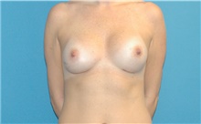Breast Implant Revision After Photo by Scott Sattler, MD,  FACS; Seattle, WA - Case 41866