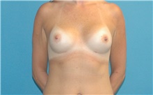 Breast Implant Revision Before Photo by Scott Sattler, MD,  FACS; Seattle, WA - Case 41866