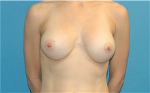 Breast Implant Revision After Photo by Scott Sattler, MD,  FACS; Seattle, WA - Case 41868