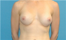 Breast Implant Revision Before Photo by Scott Sattler, MD,  FACS; Seattle, WA - Case 41868