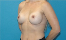 Breast Augmentation After Photo by Scott Sattler, MD,  FACS; Seattle, WA - Case 41871