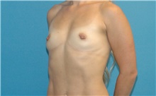 Breast Augmentation Before Photo by Scott Sattler, MD,  FACS; Seattle, WA - Case 41871
