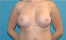 Breast Augmentation After Photo by Scott Sattler, MD,  FACS; Seattle, WA - Case 41872