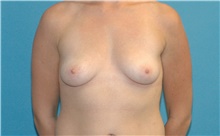 Breast Augmentation Before Photo by Scott Sattler, MD,  FACS; Seattle, WA - Case 41872