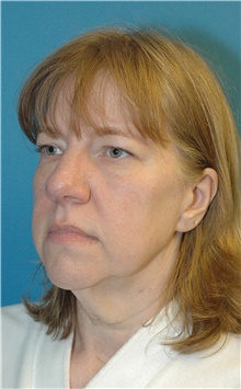 Facelift Before Photo by Scott Sattler, MD,  FACS; Seattle, WA - Case 41873