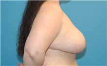 Breast Reduction After Photo by Scott Sattler, MD,  FACS; Seattle, WA - Case 41895