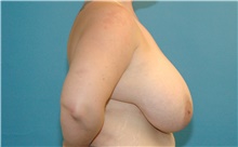 Breast Reduction Before Photo by Scott Sattler, MD,  FACS; Seattle, WA - Case 41895