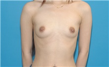 Breast Augmentation Before Photo by Scott Sattler, MD,  FACS; Seattle, WA - Case 41981