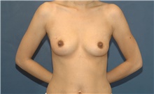 Breast Augmentation Before Photo by Scott Sattler, MD,  FACS; Seattle, WA - Case 41982