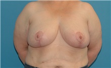 Breast Reduction After Photo by Scott Sattler, MD,  FACS; Seattle, WA - Case 41983