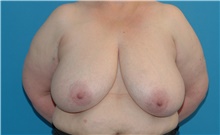 Breast Reduction Before Photo by Scott Sattler, MD,  FACS; Seattle, WA - Case 41983