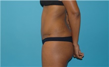 Tummy Tuck After Photo by Scott Sattler, MD,  FACS; Seattle, WA - Case 41986