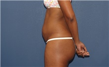 Tummy Tuck Before Photo by Scott Sattler, MD,  FACS; Seattle, WA - Case 41986