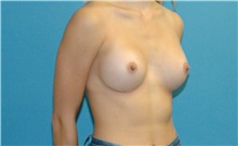 Breast Augmentation After Photo by Scott Sattler, MD,  FACS; Seattle, WA - Case 42058