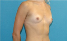 Breast Augmentation Before Photo by Scott Sattler, MD,  FACS; Seattle, WA - Case 42058