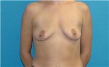 Breast Augmentation Before Photo by Scott Sattler, MD,  FACS; Seattle, WA - Case 42468