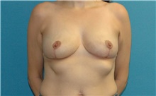 Breast Lift After Photo by Scott Sattler, MD,  FACS; Seattle, WA - Case 44695