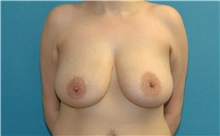 Breast Lift Before Photo by Scott Sattler, MD,  FACS; Seattle, WA - Case 44695