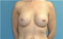 Breast Augmentation After Photo by Scott Sattler, MD,  FACS; Seattle, WA - Case 45940