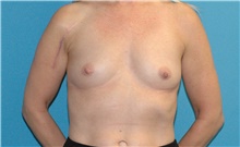 Breast Augmentation Before Photo by Scott Sattler, MD,  FACS; Seattle, WA - Case 45940