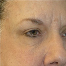 Eyelid Surgery After Photo by Scott Sattler, MD,  FACS; Seattle, WA - Case 46051