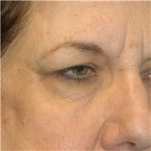 Eyelid Surgery Before Photo by Scott Sattler, MD,  FACS; Seattle, WA - Case 46051