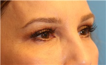 Eyelid Surgery After Photo by Scott Sattler, MD,  FACS; Seattle, WA - Case 46052
