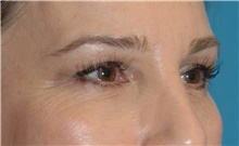 Eyelid Surgery Before Photo by Scott Sattler, MD,  FACS; Seattle, WA - Case 46052