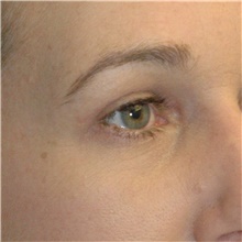 Eyelid Surgery After Photo by Scott Sattler, MD,  FACS; Seattle, WA - Case 46053