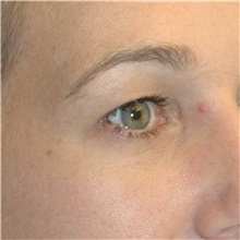 Eyelid Surgery Before Photo by Scott Sattler, MD,  FACS; Seattle, WA - Case 46053