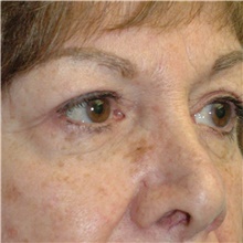 Eyelid Surgery After Photo by Scott Sattler, MD,  FACS; Seattle, WA - Case 46054