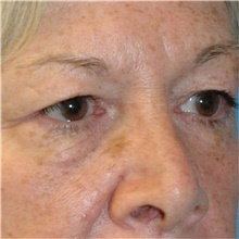 Eyelid Surgery Before Photo by Scott Sattler, MD,  FACS; Seattle, WA - Case 46054