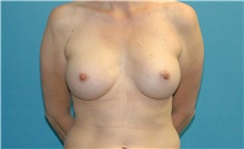 Breast Augmentation After Photo by Scott Sattler, MD,  FACS; Seattle, WA - Case 46158