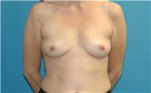 Breast Augmentation Before Photo by Scott Sattler, MD,  FACS; Seattle, WA - Case 46158
