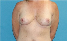 Breast Lift After Photo by Scott Sattler, MD,  FACS; Seattle, WA - Case 46216
