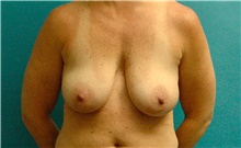 Breast Lift Before Photo by Scott Sattler, MD,  FACS; Seattle, WA - Case 46216