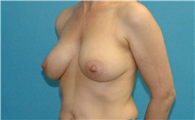Breast Lift Before Photo by Scott Sattler, MD,  FACS; Seattle, WA - Case 46373