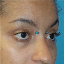 Eyelid Surgery After Photo by Scott Sattler, MD,  FACS; Seattle, WA - Case 46378