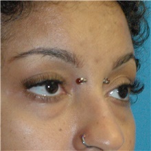 Eyelid Surgery Before Photo by Scott Sattler, MD,  FACS; Seattle, WA - Case 46378