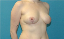 Breast Lift After Photo by Scott Sattler, MD,  FACS; Seattle, WA - Case 46380