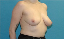 Breast Lift Before Photo by Scott Sattler, MD,  FACS; Seattle, WA - Case 46380
