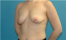 Breast Augmentation Before Photo by Scott Sattler, MD,  FACS; Seattle, WA - Case 46384