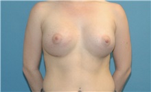 Breast Augmentation After Photo by Scott Sattler, MD,  FACS; Seattle, WA - Case 46387