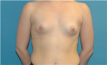 Breast Augmentation Before Photo by Scott Sattler, MD,  FACS; Seattle, WA - Case 46387
