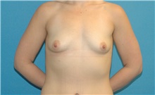 Breast Augmentation Before Photo by Scott Sattler, MD,  FACS; Seattle, WA - Case 46388