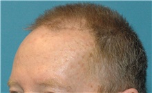 Hair Transplant Before Photo by Scott Sattler, MD,  FACS; Seattle, WA - Case 46394