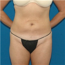 Liposuction After Photo by Scott Sattler, MD,  FACS; Seattle, WA - Case 46395