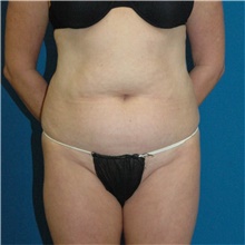 Liposuction Before Photo by Scott Sattler, MD,  FACS; Seattle, WA - Case 46395