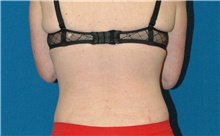 Liposuction After Photo by Scott Sattler, MD,  FACS; Seattle, WA - Case 46396