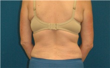 Liposuction Before Photo by Scott Sattler, MD,  FACS; Seattle, WA - Case 46396